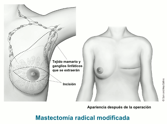 illustration showing the incision, breast tissue and lymph nodes to be removed and the postoperative appearance