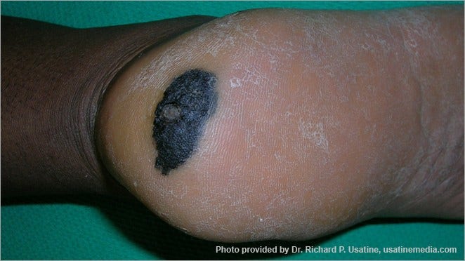 Melanoma on the heel of the foot, appearing on dark skin as a large, dark, asymmetrical area with a jagged border.