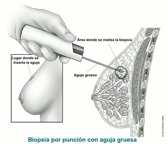 Ilustración de biopsia por punción con aguja gruesa