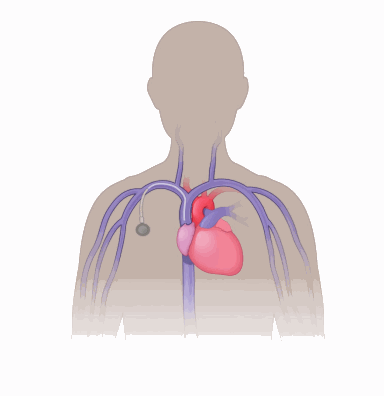 illustration showing a single port (also called an implantable venous access port)