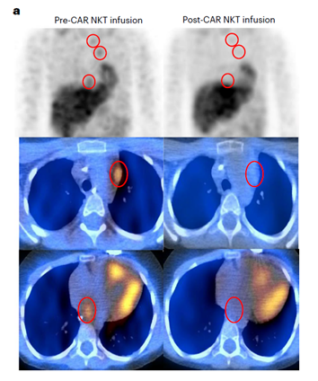 Pre and post-CAR NKT scan from childhood cancer research highlight by Heczey