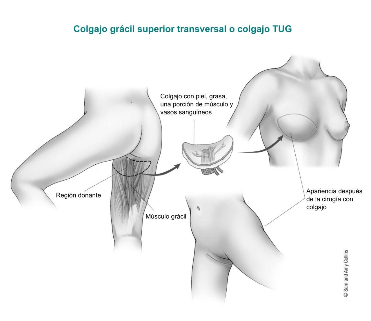 Colgajo grácil superior transversal o colgajo TUG