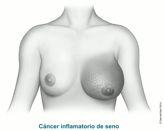 illustration showing a breast with inflammatory breast cancer
