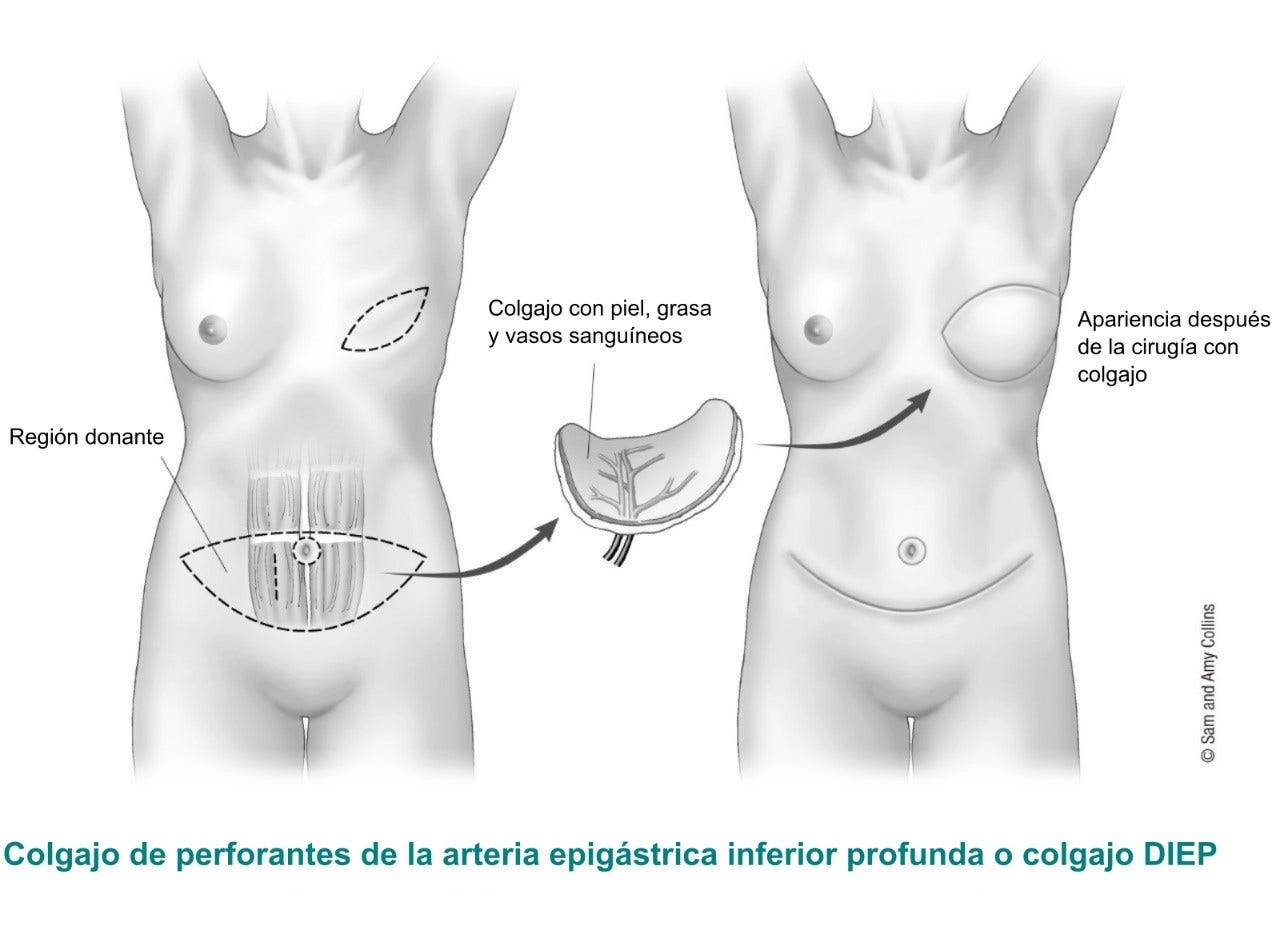 Deep Inferior Epigastric Artery Perforator or DIEP Flap 