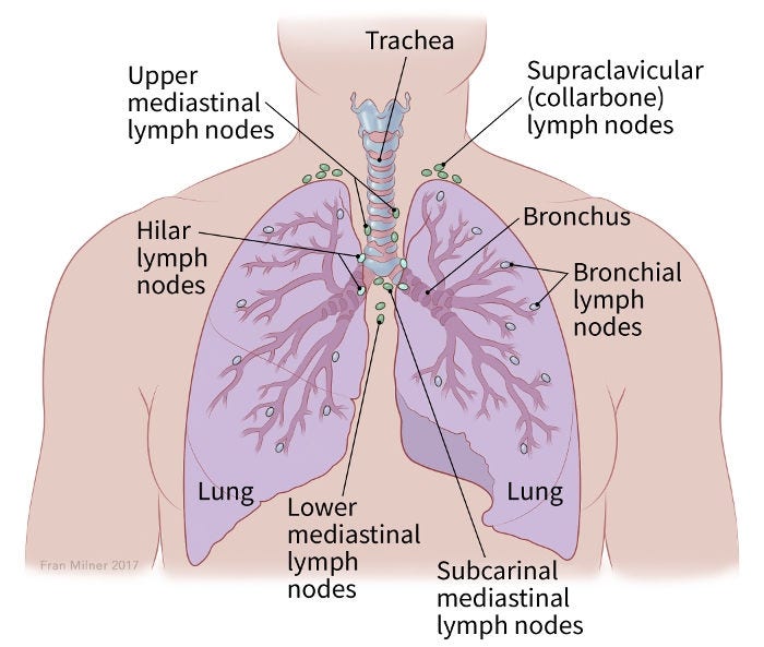 Lung Carcinoid Tumor Stages Staging Lung Neuroendocrine Tumors