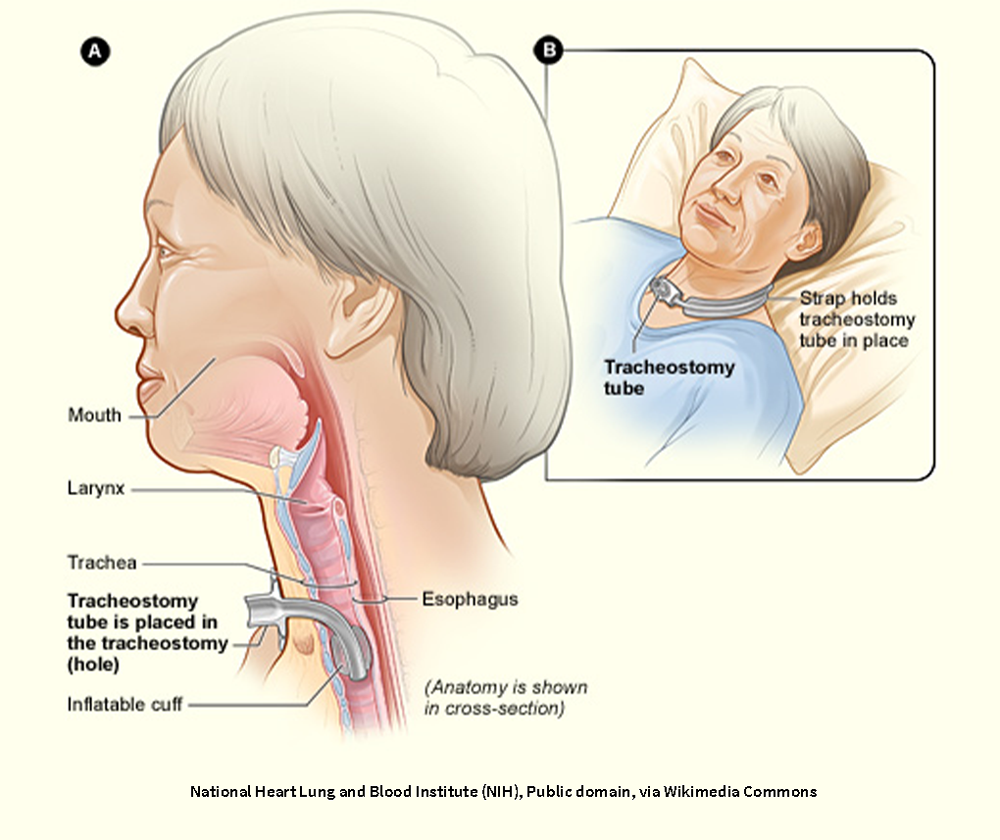 Figure A shows a side view of the neck and the correct placement of a tracheostomy tube in the trachea, or windpipe. Figure B shows an external view of a patient who has a tracheostomy.