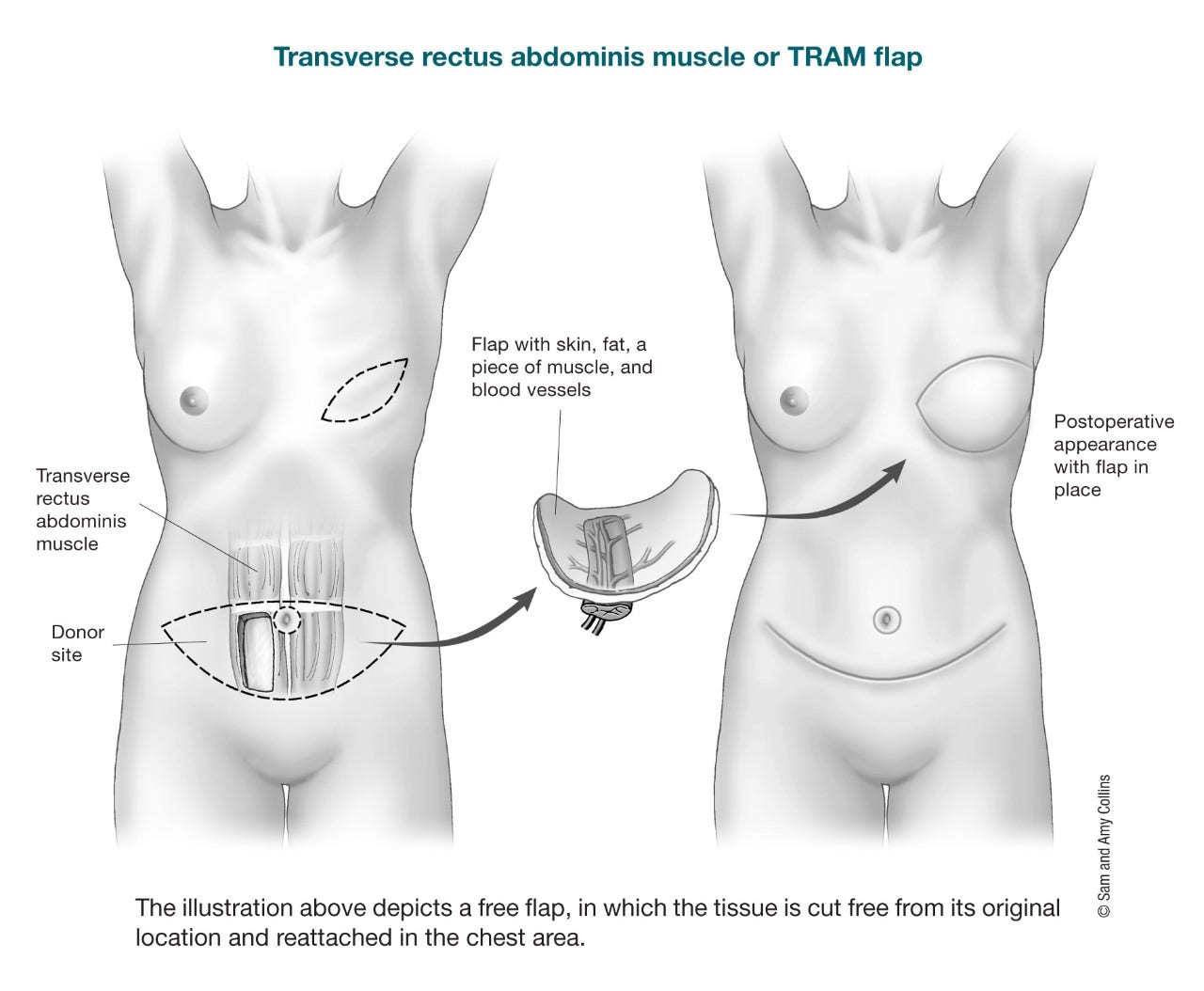 Flap Procedures  Breast Reconstruction Using Your Own Tissue