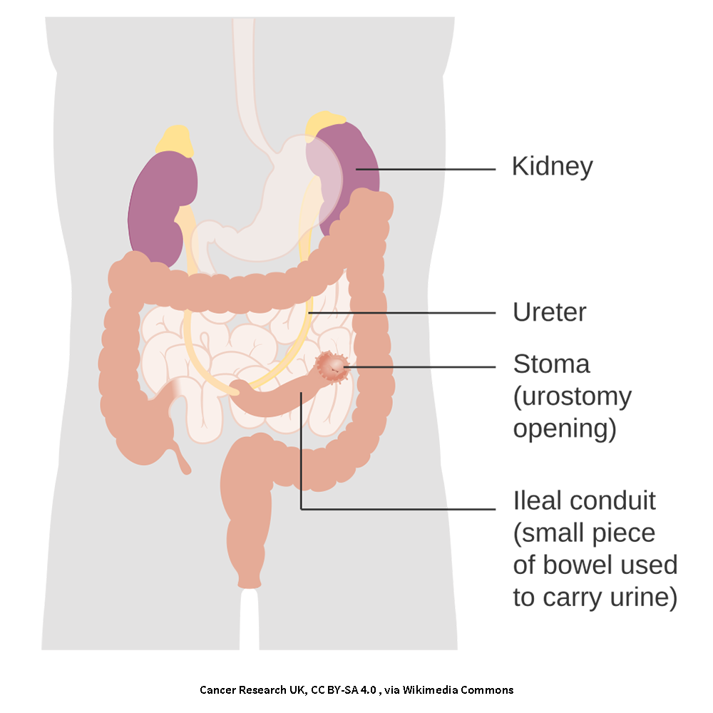 Diagram showing how a urostomy is made using an ileal conduit technique.