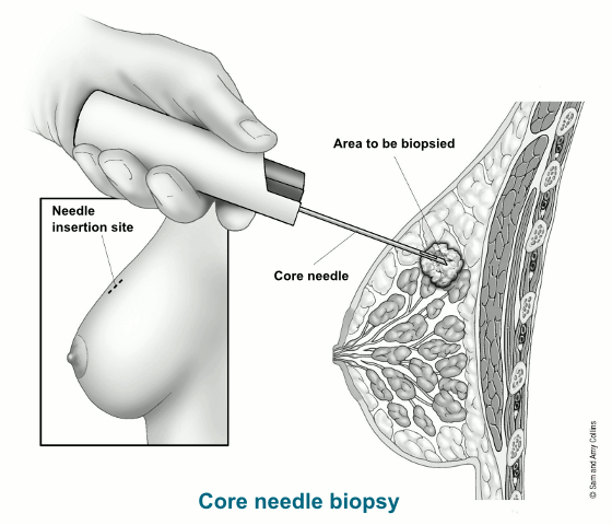 Size matters: The impact of proper needle selection and management