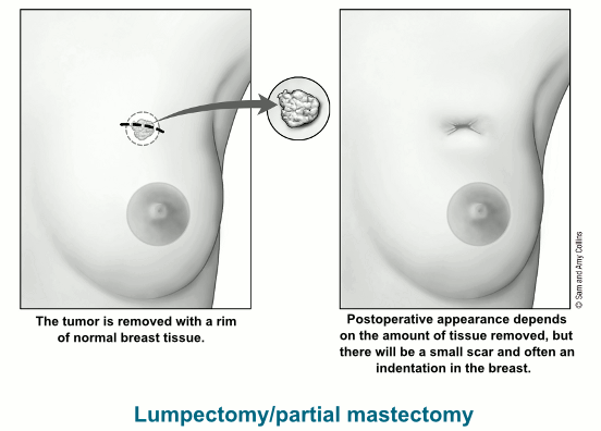 illustration showing the area of the breast where a tumor is removed with a rim of normal breast tissue as well as postoperative appearance