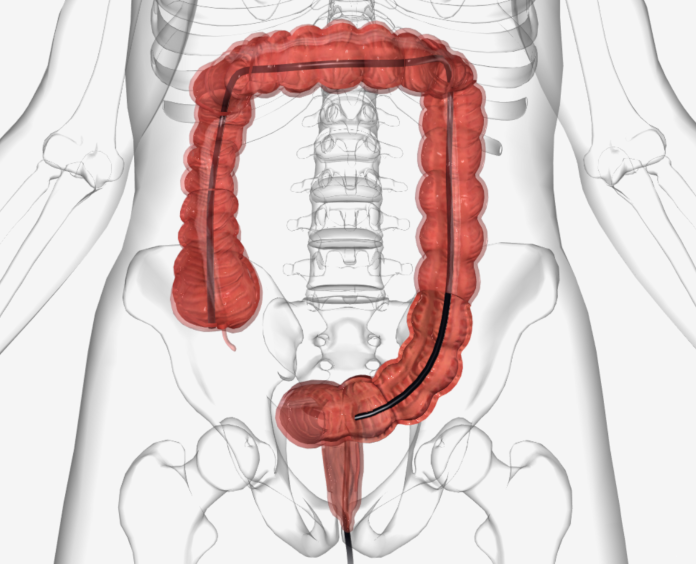 still showing the placement of a colonoscope in the colon during a colonoscopy