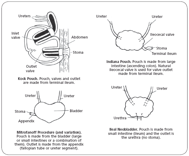 illustration showing details of four types of urostomies: kock pouch, indiana pouch, mitrofanoff procedure and variation and ileal neobladder