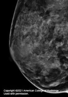 mammogram image showing a breast that is extremely dense, which makes it hard to see tumors in the tissue