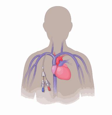 illustration showing the location of a tunneled venous catheter