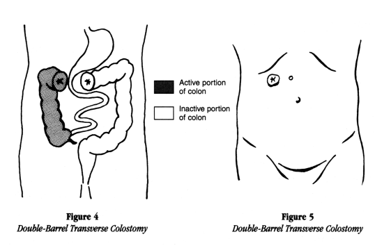 illustration showing a double barrel transverse colostomy from inside the body and from outside including the active and inactive portions of the colon