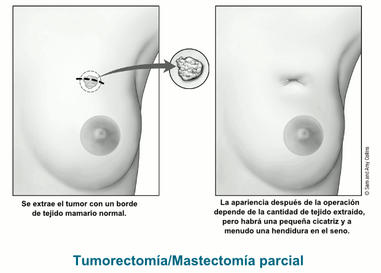 illustration showing the area of the breast where a tumor is removed with a rim of normal breast tissue as well as postoperative appearance