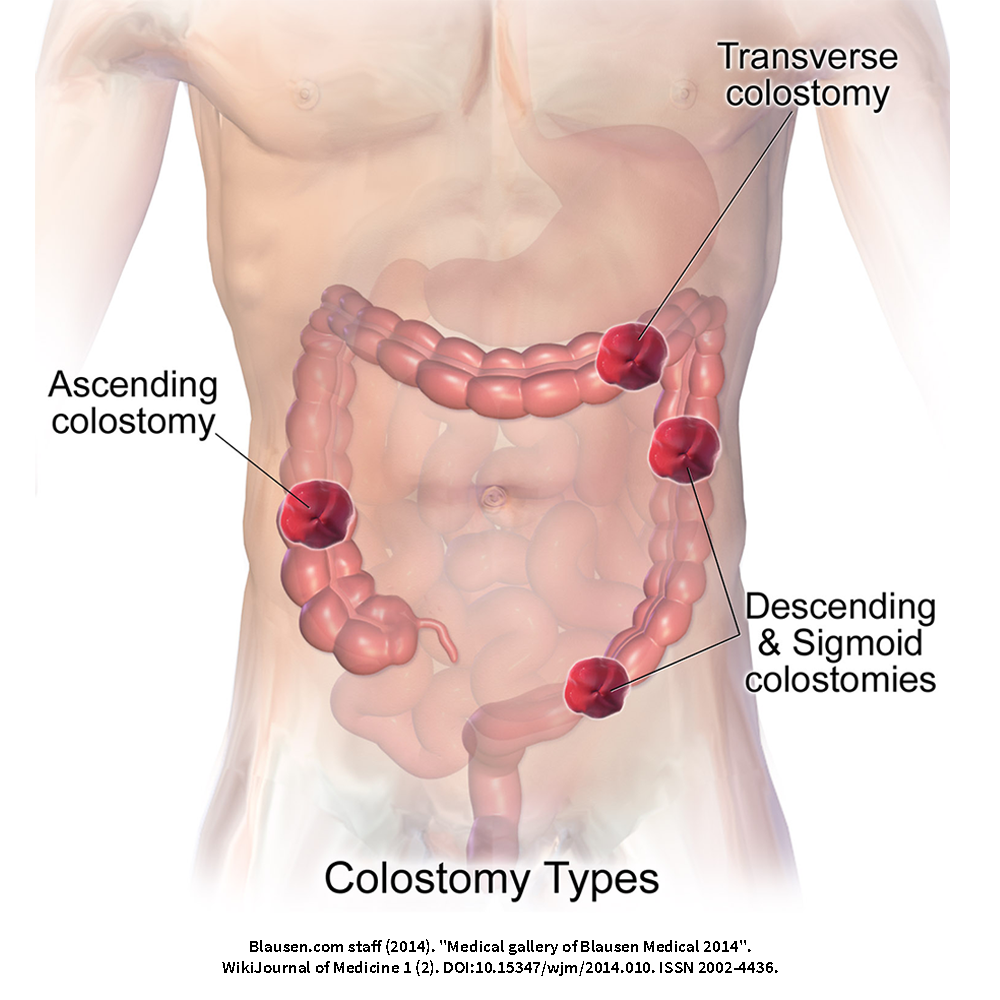This image shows the placement of different types of ostomies on a person’s abdomen. It shows the position of an ascending colostomy on the right side of the abdomen, a transverse colostomy on the upper left part of the abdomen, and a descending and a sigmoid colostomy on the lower left side of the abdomen.
