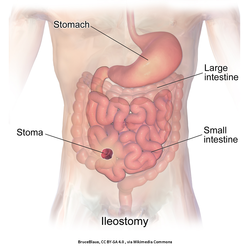 This image shows the placement of an ileostomy on a person’s abdomen.