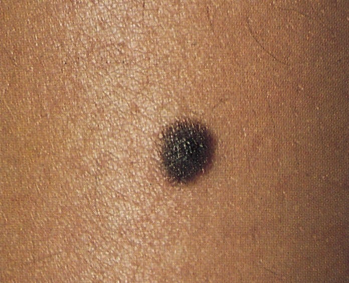 Close up of a normal mole on someone's skin