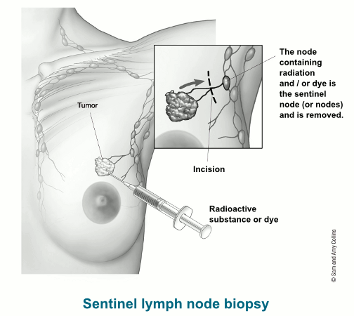 illustration showing the radioactive substance or dye being injected into tumor with details of the incision and the sentinel node that is removed