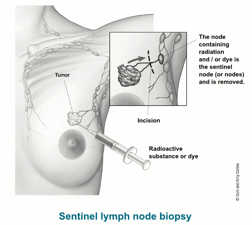 B. on X: Almost recovered from my Tumor removal and Breast