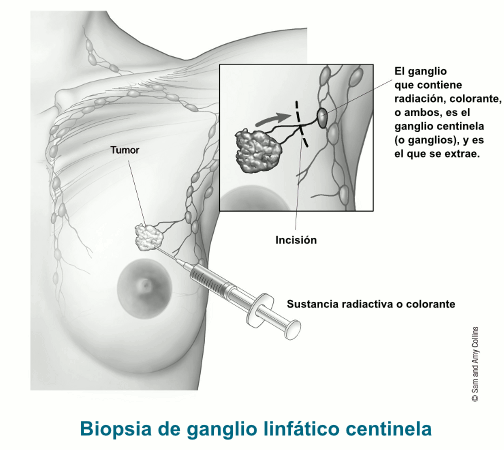 illustration showing the radioactive substance or dye being injected into tumor with details of the incision and the sentinel node that is removed