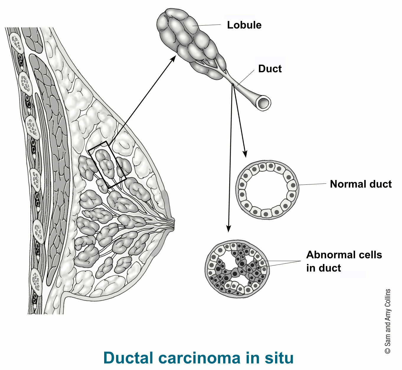 Ductal Carcinoma in Situ (DCIS) | American Cancer Society