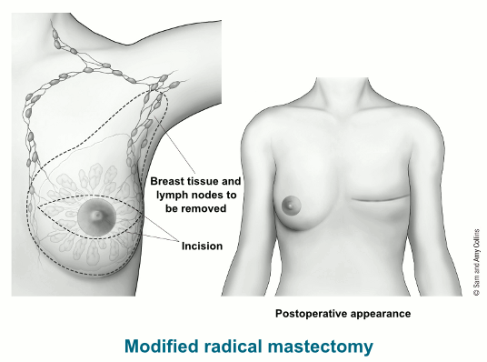 Boob classification