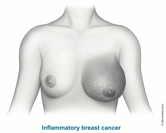 illustration showing a breast with inflammatory breast cancer