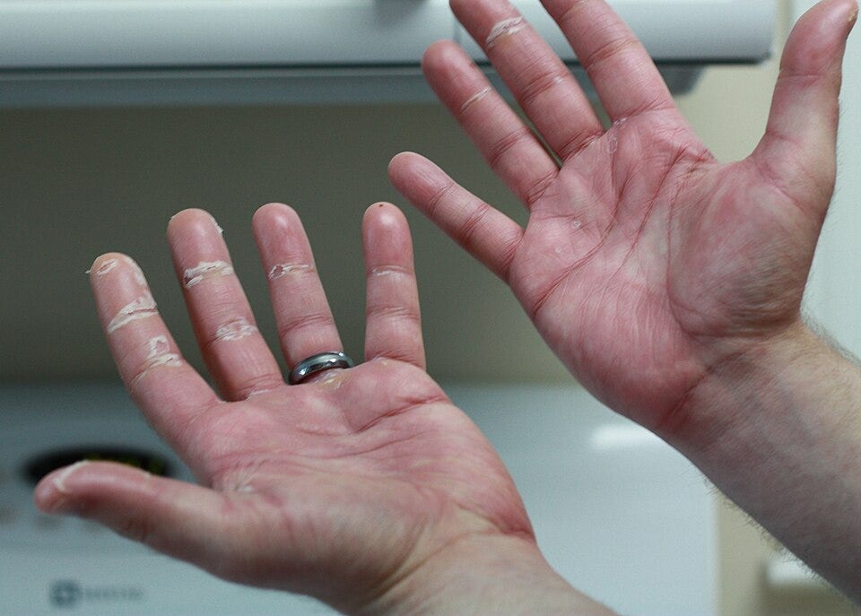 Hands, palm up, showing peeling of skin at creases of fingers.