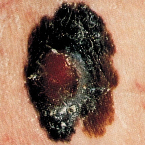 Close-up photo of mole showing asymmetry, border irregularity, and color