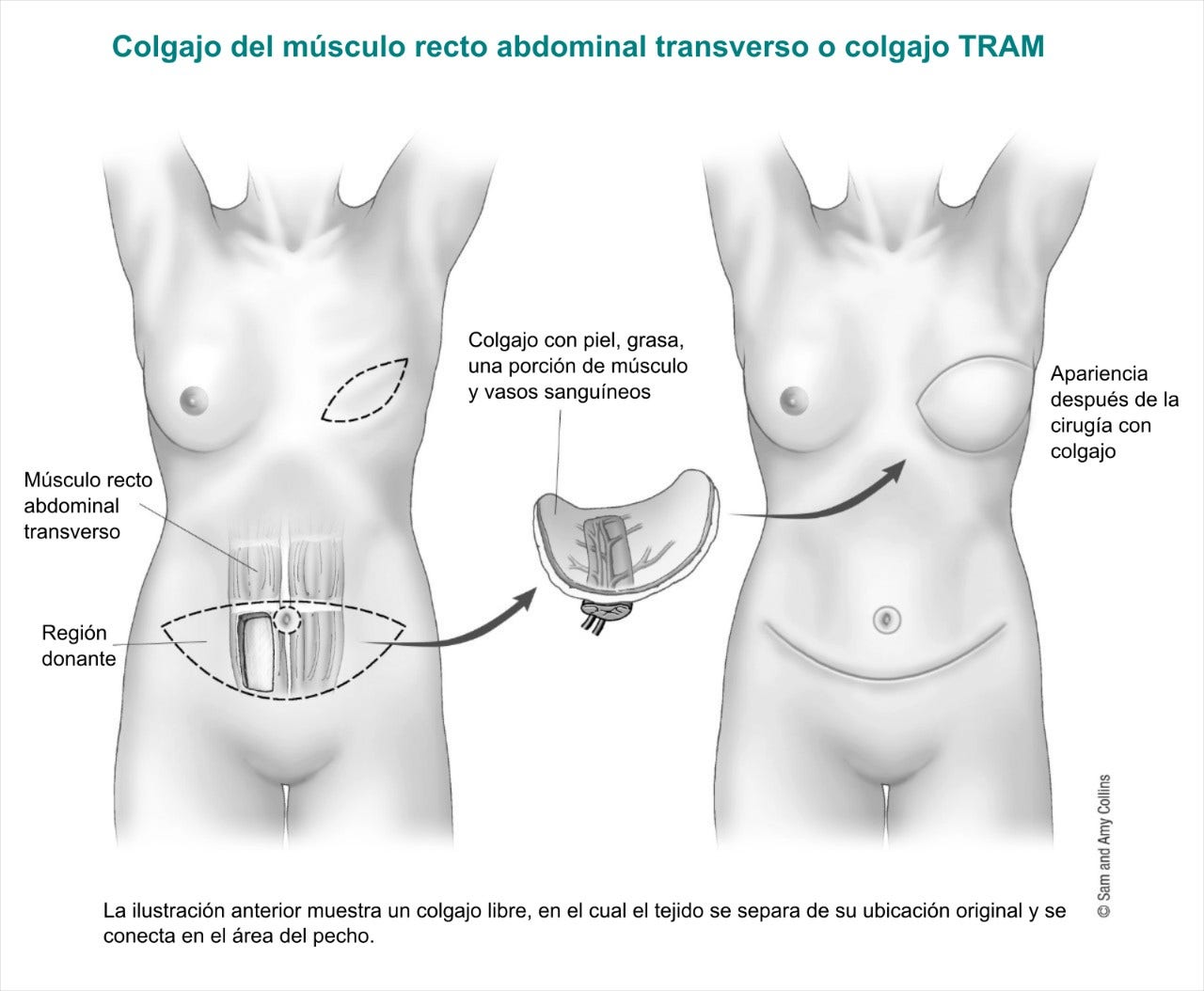 Transverse rectus abdominis muscle or Tram flap 