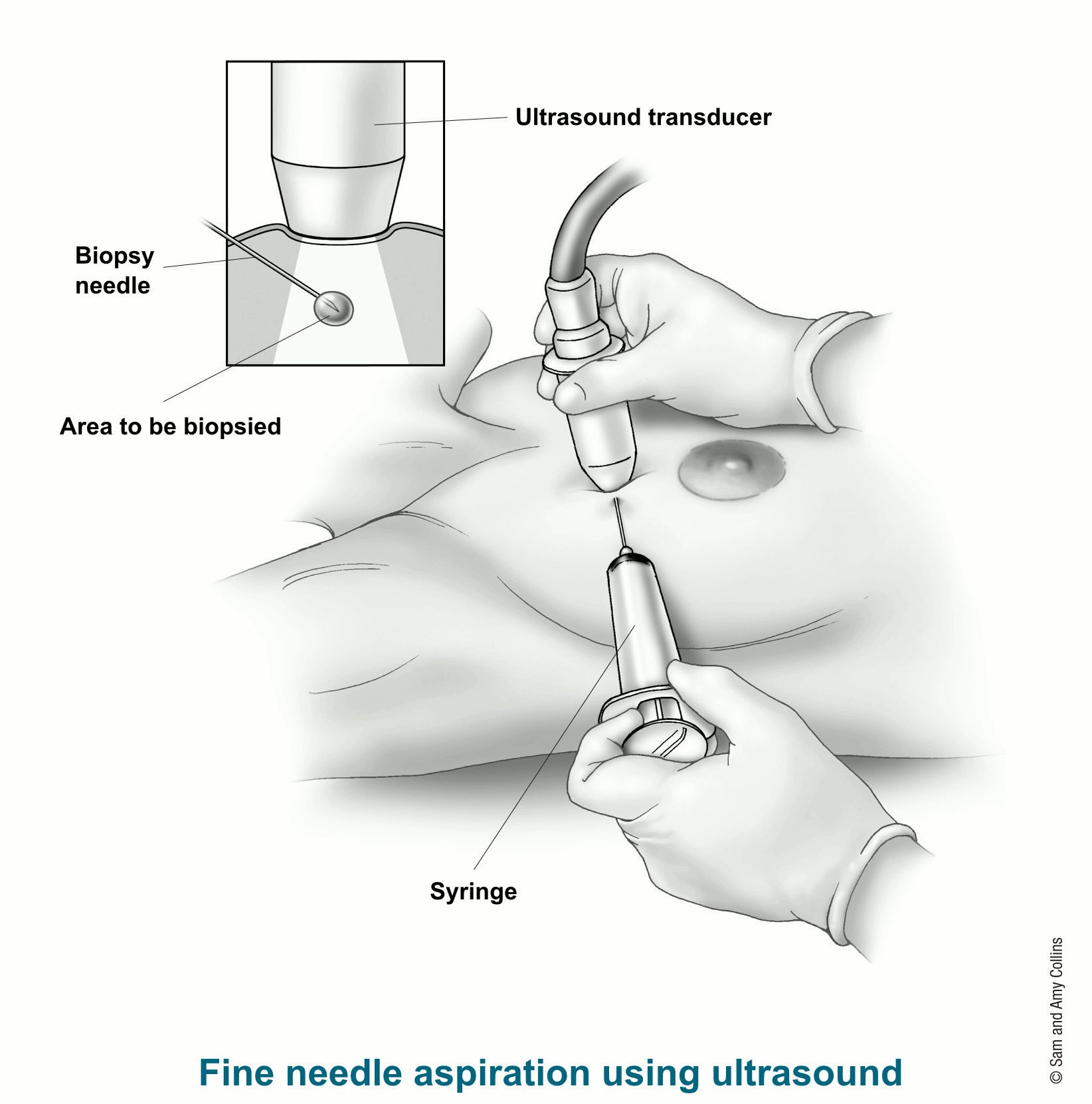 Fine Needle Aspiration (FNA) of the Breast