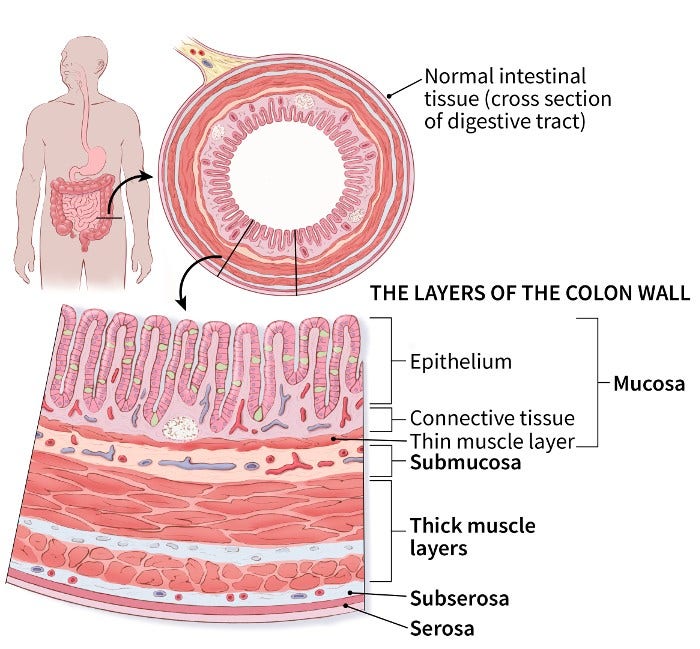 colon cancer stage 0