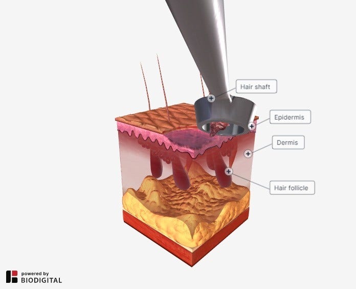 Curettage and Electrodesiccation