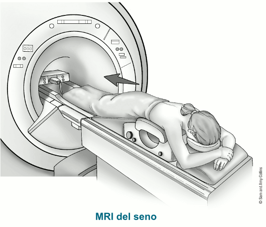 illustration showing woman as she gets a breast mri