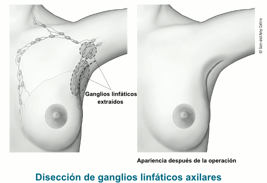 two illustrations showing lymph nodes removed with axillary lymph node dissection and the postoperative appearance