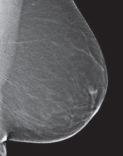 A 69-year-old woman with  non-dense  breast composition, small