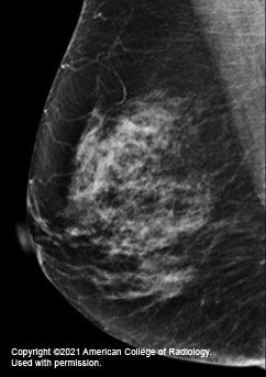 A 69-year-old woman with  non-dense  breast composition, small