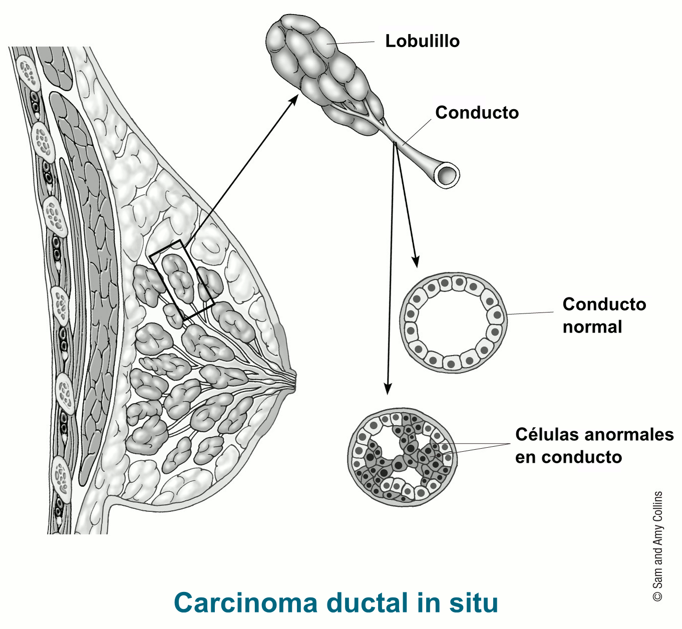 illustration showing details of ductal carcinoma in situ including lobule, duct, normal duct and abnormal cells in duct