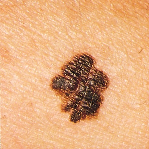 Close-up photo of mole showing asymmetry, border irregularity, and color