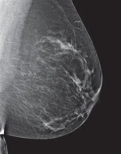 A 69-year-old woman with  non-dense  breast composition, small