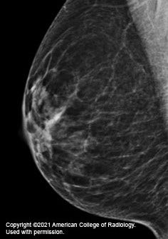 mammogram image showing a breast that has scattered areas of dense glandular and fibrous tissue