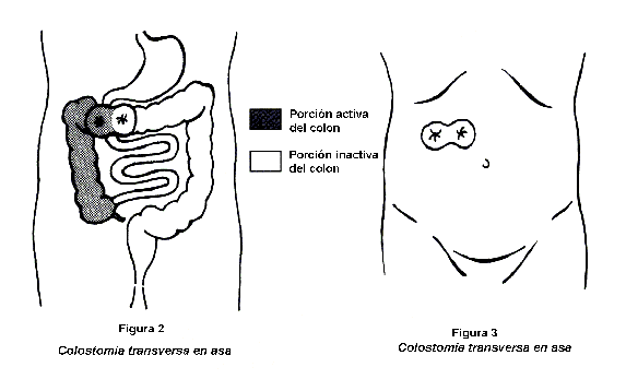 Tipos de colostomías y sistemas de bolsa recolectora