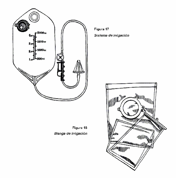 colostomy-irrigation-system-and-sleeve-spanish.gif