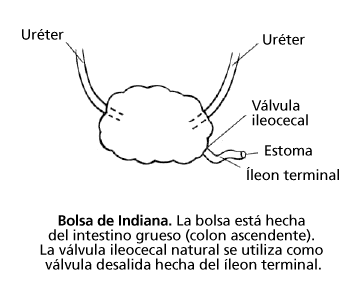 continent-urostomies-indiana-pouch-spanish.gif