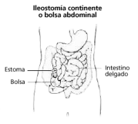 continent-ileostomy-or-abdominal pouch-spanish.gif