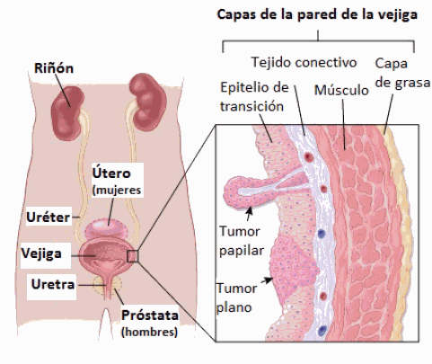 Illustration showing the location of the bladder in relation to the kidneys, uterus (in women), prostate (in men), ureter and urethra. There is also a close up showing the layers of the bladder wall with papillary and flat tumors.