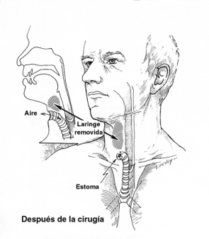 laryngectomy-after-surgery-spanish.gif