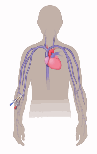 illustration showing the location of a PICC line